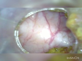 গভীর গভীর পায়ুপথ আবার বাড়ি colonoscopy endoscope অংশ 1