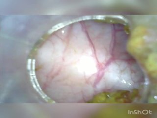 深 深 肛門 再次 家 colonoscopy endoscope 部分 1